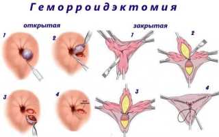 Лекарственные формы для лечения геморроя